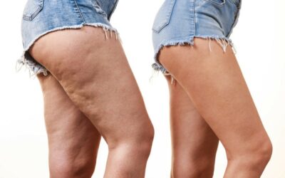 Comment lutter contre la cellulite