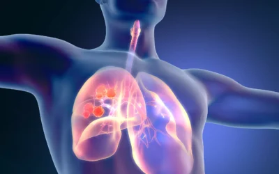 Est-il possible de guérir d’un cancer ?